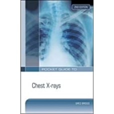 Pocket Guide to Chest X-Rays